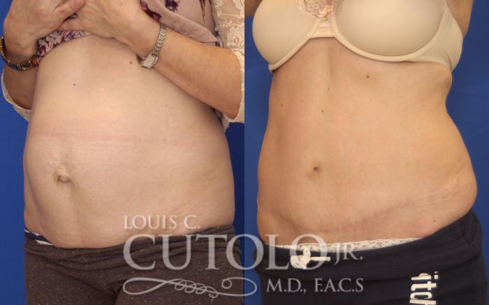 Before & After Tummy Tuck Case 143 View #2 View in Brooklyn, Staten Island, Queens, NY