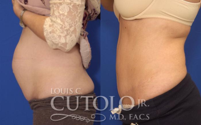 Before & After Tummy Tuck Case 143 View #3 View in Brooklyn, Staten Island, Queens, NY