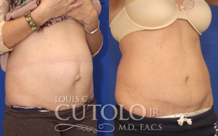 Before & After Tummy Tuck Case 143 View #4 View in Brooklyn, Staten Island, Queens, NY