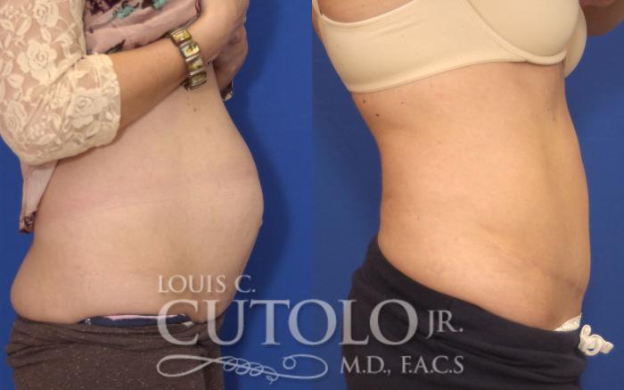Before & After Tummy Tuck Case 143 View #5 View in Brooklyn, Staten Island, Queens, NY
