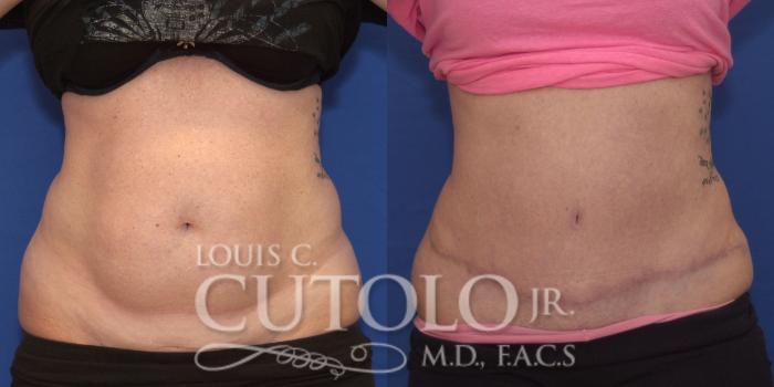 Before & After Tummy Tuck Case 157 View #1 View in Brooklyn, Staten Island, Queens, NY