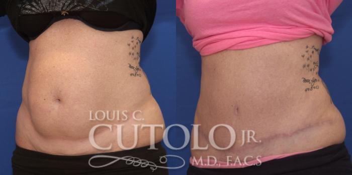 Before & After Tummy Tuck Case 157 View #2 View in Brooklyn, Staten Island, Queens, NY