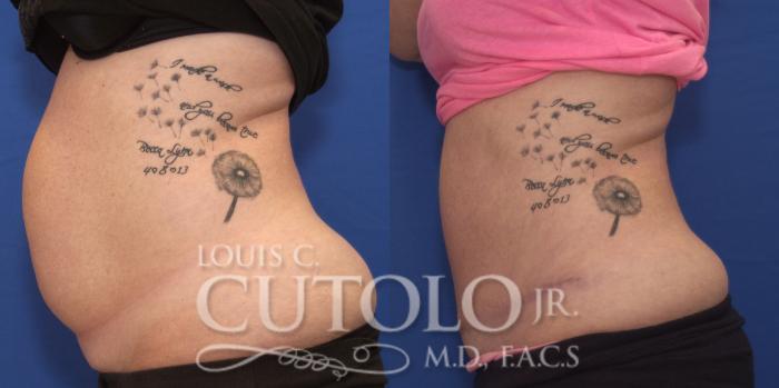 Before & After Tummy Tuck Case 157 View #3 View in Brooklyn, Staten Island, Queens, NY