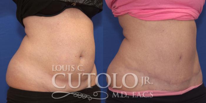 Before & After Tummy Tuck Case 157 View #4 View in Brooklyn, Staten Island, Queens, NY