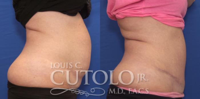 Before & After Tummy Tuck Case 157 View #5 View in Brooklyn, Staten Island, Queens, NY