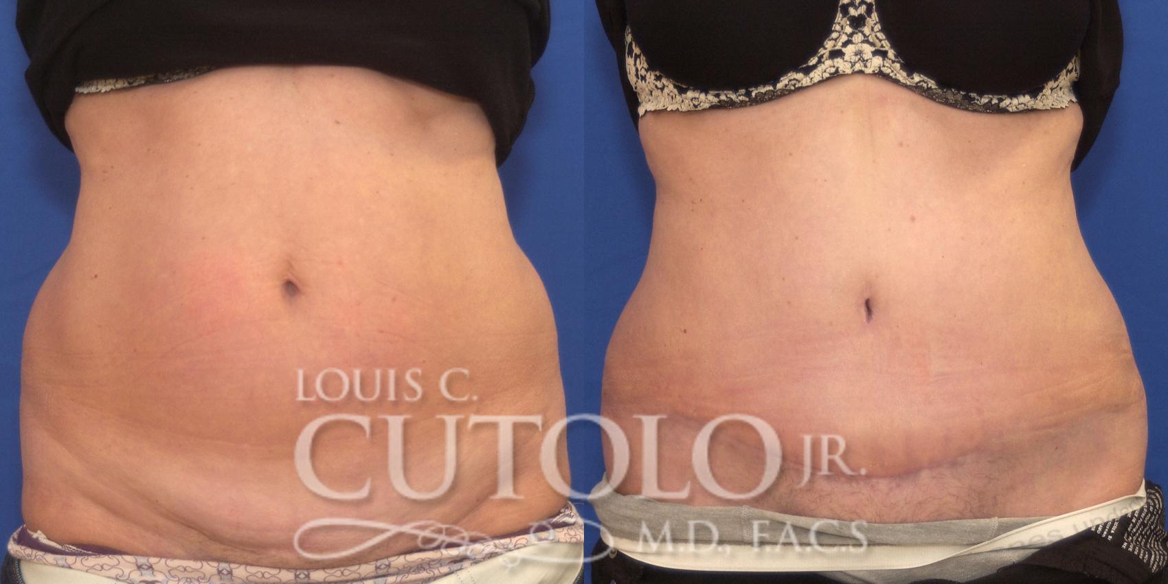 Before & After Tummy Tuck Case 165 View #1 View in Brooklyn, Staten Island, Queens, NY
