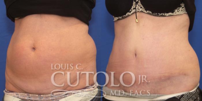 Before & After Tummy Tuck Case 165 View #2 View in Brooklyn, Staten Island, Queens, NY