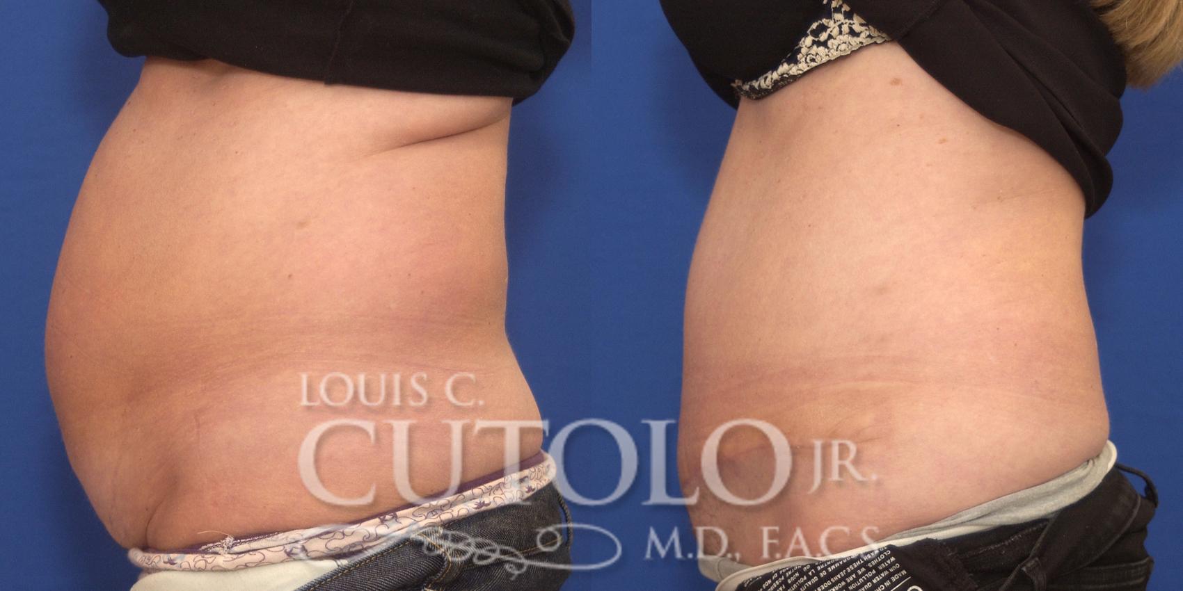 Before & After Tummy Tuck Case 165 View #3 View in Brooklyn, Staten Island, Queens, NY