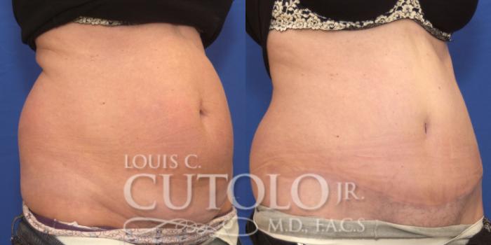 Before & After Tummy Tuck Case 165 View #4 View in Brooklyn, Staten Island, Queens, NY
