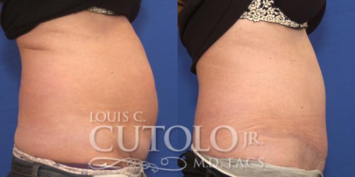 Before & After Tummy Tuck Case 165 View #5 View in Brooklyn, Staten Island, Queens, NY