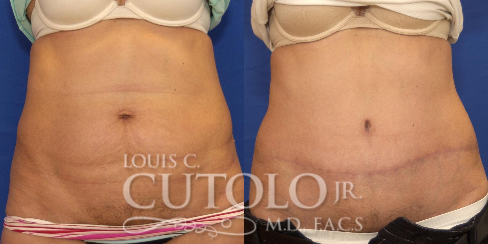 Before & After Tummy Tuck Case 177 View #1 View in Brooklyn, Staten Island, Queens, NY