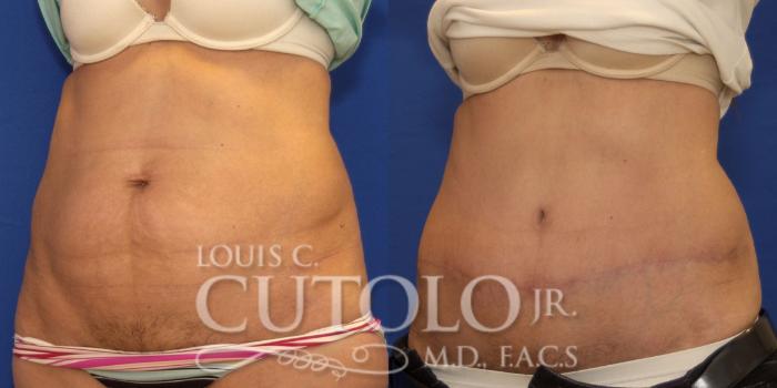 Before & After Tummy Tuck Case 177 View #2 View in Brooklyn, Staten Island, Queens, NY