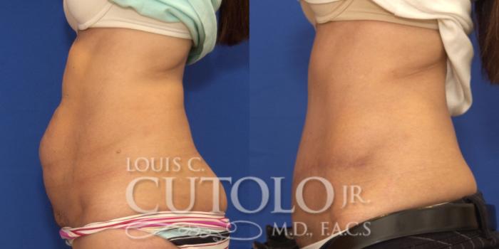 Before & After Tummy Tuck Case 177 View #3 View in Brooklyn, Staten Island, Queens, NY