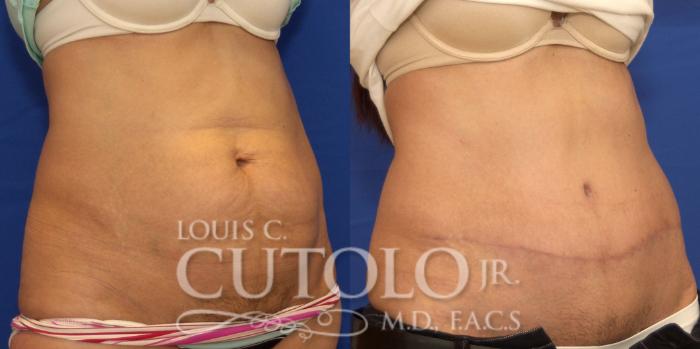 Before & After Tummy Tuck Case 177 View #4 View in Brooklyn, Staten Island, Queens, NY