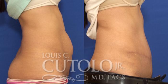 Before & After Tummy Tuck Case 177 View #5 View in Brooklyn, Staten Island, Queens, NY