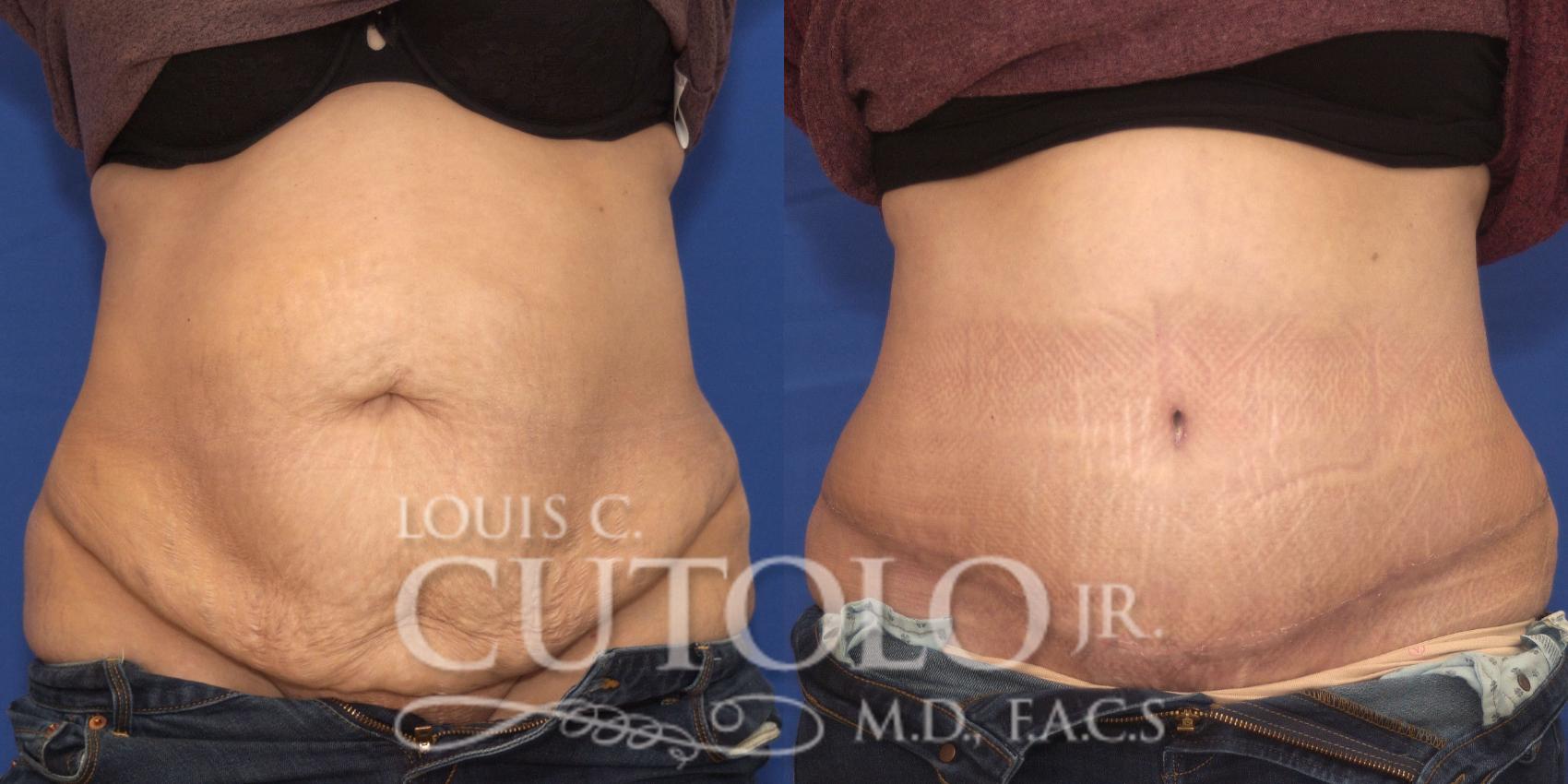 Before & After Tummy Tuck Case 189 View #1 View in Brooklyn, Staten Island, Queens, NY