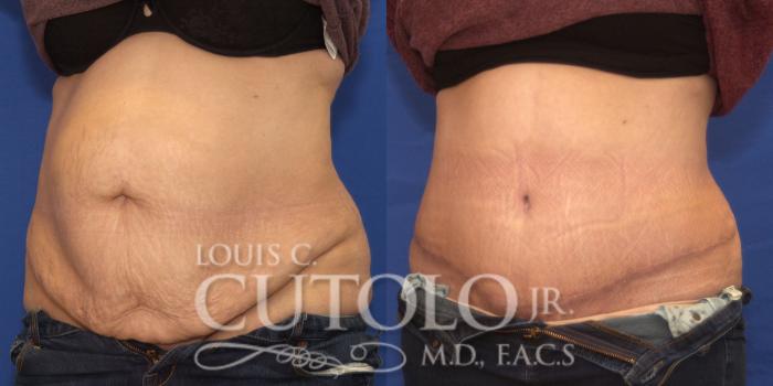 Before & After Tummy Tuck Case 189 View #2 View in Brooklyn, Staten Island, Queens, NY