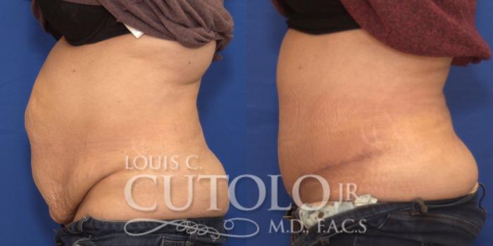 Before & After Tummy Tuck Case 189 View #3 View in Brooklyn, Staten Island, Queens, NY
