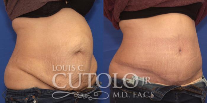 Before & After Tummy Tuck Case 189 View #4 View in Brooklyn, Staten Island, Queens, NY