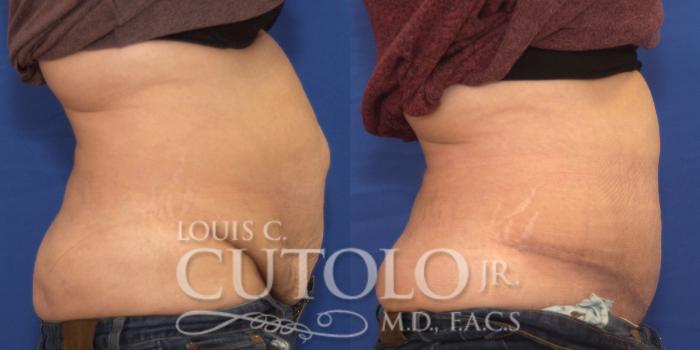 Before & After Tummy Tuck Case 189 View #5 View in Brooklyn, Staten Island, Queens, NY