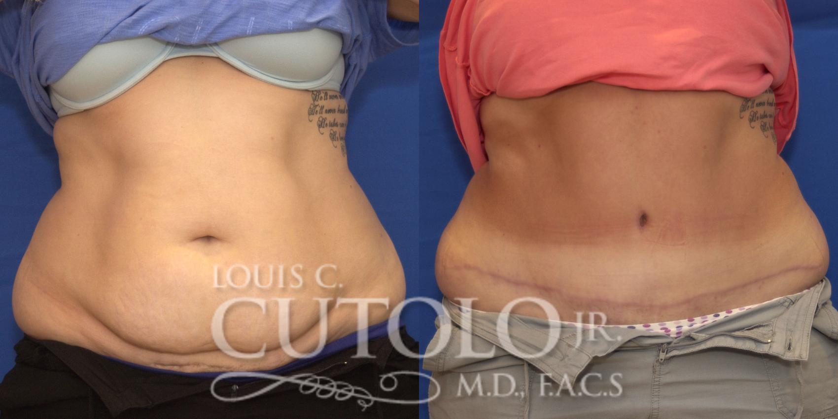 Before & After Tummy Tuck Case 193 View #1 View in Brooklyn, Staten Island, Queens, NY
