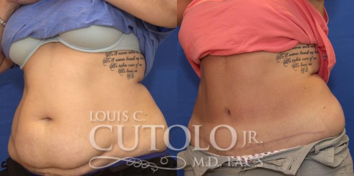 Before & After Tummy Tuck Case 193 View #2 View in Brooklyn, Staten Island, Queens, NY