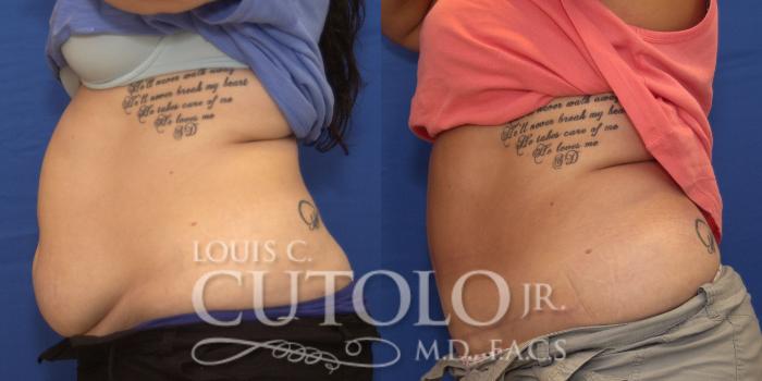 Before & After Tummy Tuck Case 193 View #3 View in Brooklyn, Staten Island, Queens, NY