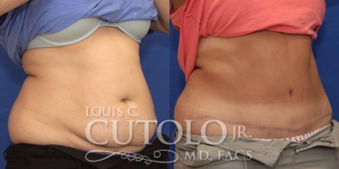 Before & After Tummy Tuck Case 193 View #4 View in Brooklyn, Staten Island, Queens, NY