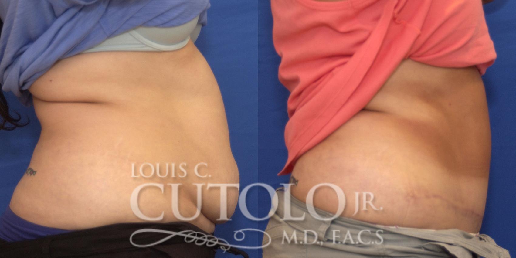 Before & After Tummy Tuck Case 193 View #5 View in Brooklyn, Staten Island, Queens, NY