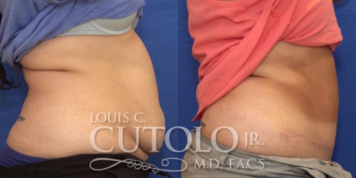 Before & After Tummy Tuck Case 193 View #5 View in Brooklyn, Staten Island, Queens, NY