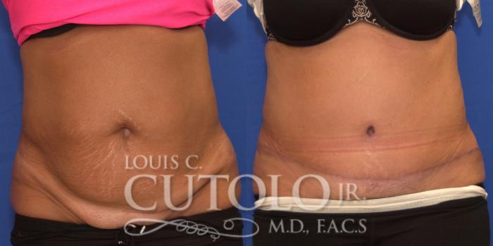 Before & After Tummy Tuck Case 198 View #1 View in Brooklyn, Staten Island, Queens, NY