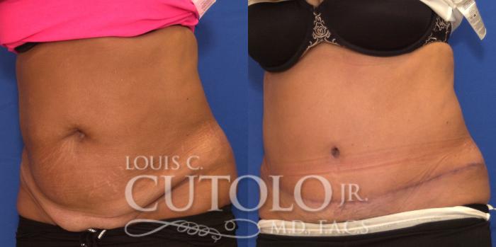Before & After Tummy Tuck Case 198 View #2 View in Brooklyn, Staten Island, Queens, NY