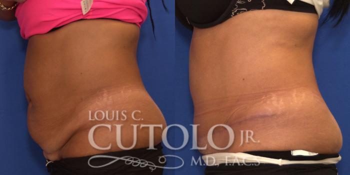 Before & After Tummy Tuck Case 198 View #3 View in Brooklyn, Staten Island, Queens, NY