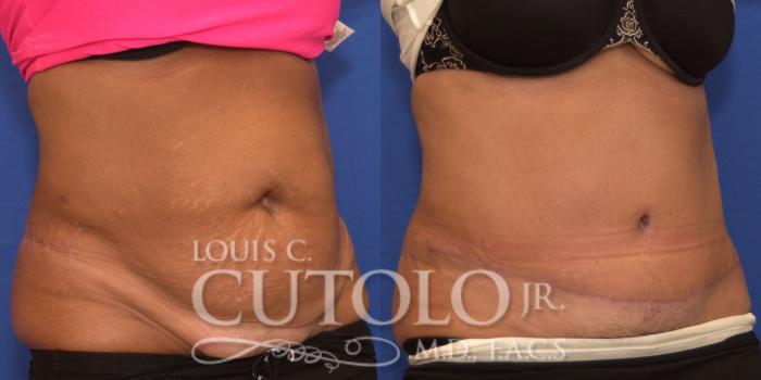 Before & After Tummy Tuck Case 198 View #4 View in Brooklyn, Staten Island, Queens, NY