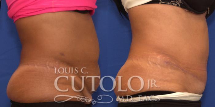 Before & After Tummy Tuck Case 198 View #5 View in Brooklyn, Staten Island, Queens, NY
