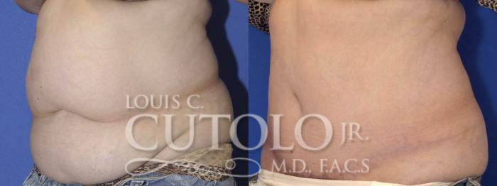 Before & After Tummy Tuck Case 2 View #2 View in Brooklyn, Staten Island, Queens, NY