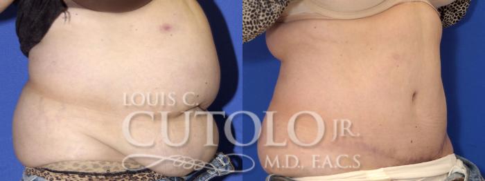 Before & After Tummy Tuck Case 2 View #3 View in Brooklyn, Staten Island, Queens, NY