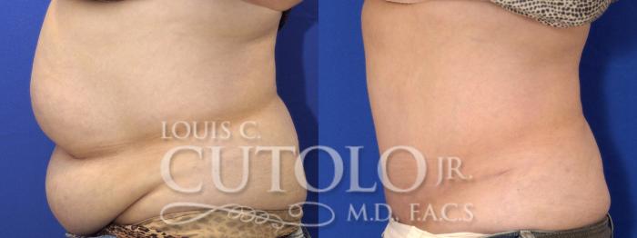 Before & After Tummy Tuck Case 2 View #4 View in Brooklyn, Staten Island, Queens, NY