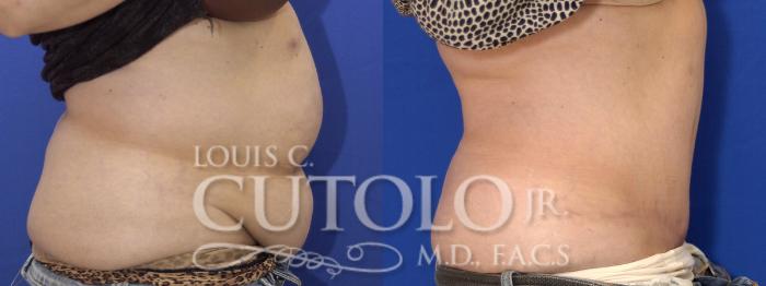 Before & After Tummy Tuck Case 2 View #5 View in Brooklyn, Staten Island, Queens, NY