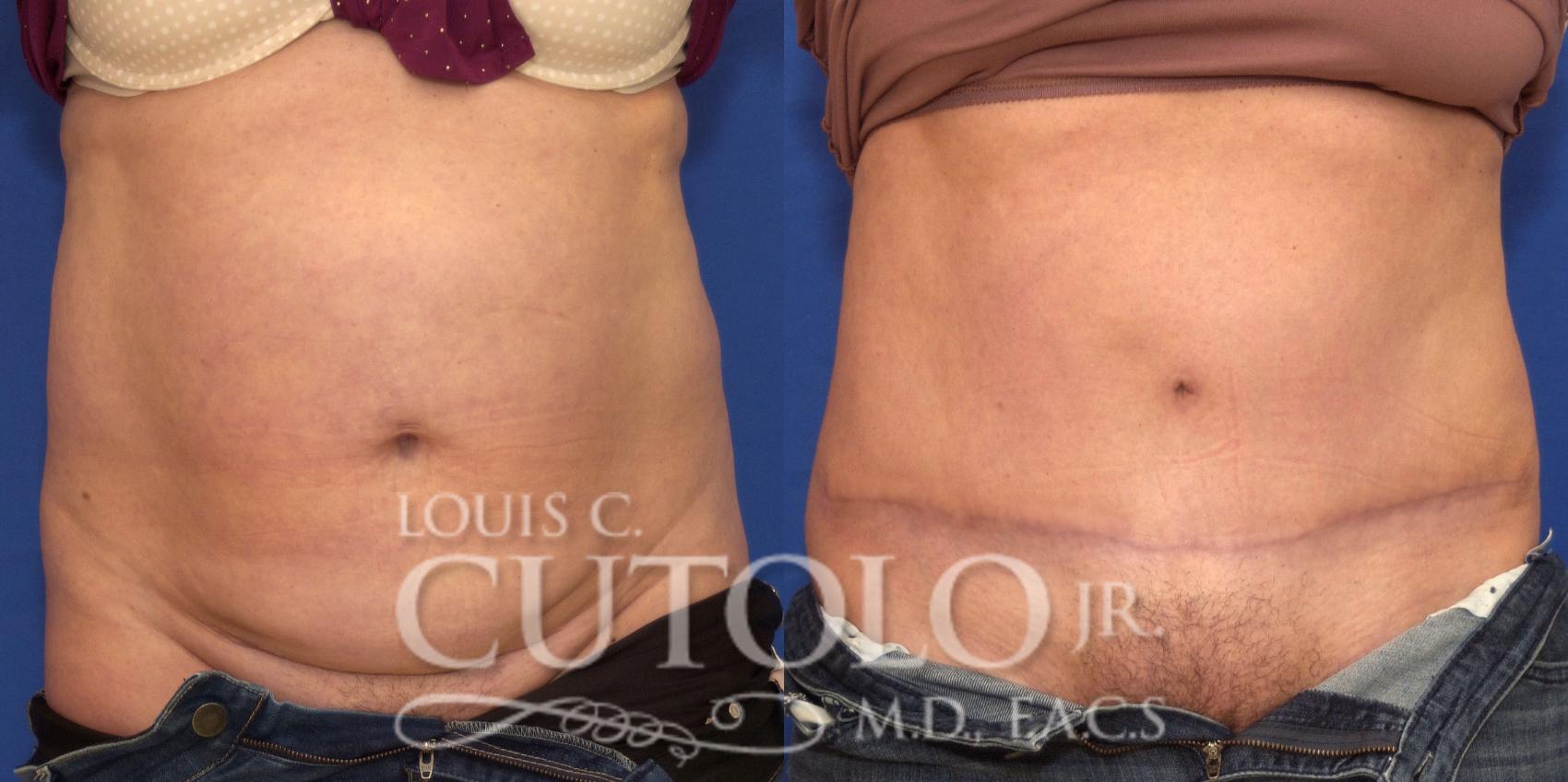 Before & After Tummy Tuck Case 205 View #1 View in Brooklyn, Staten Island, Queens, NY