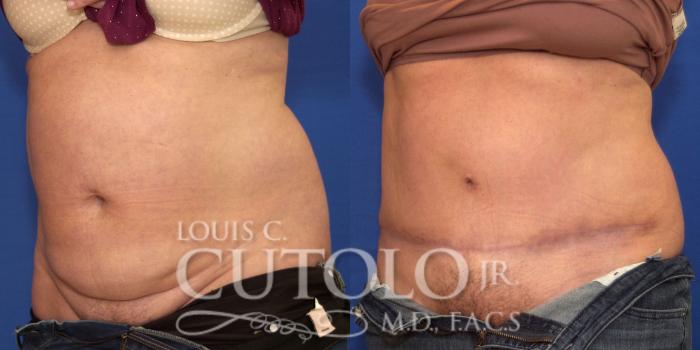 Before & After Tummy Tuck Case 205 View #2 View in Brooklyn, Staten Island, Queens, NY