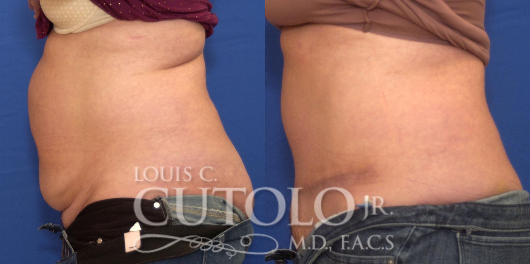 Before & After Tummy Tuck Case 205 View #3 View in Brooklyn, Staten Island, Queens, NY