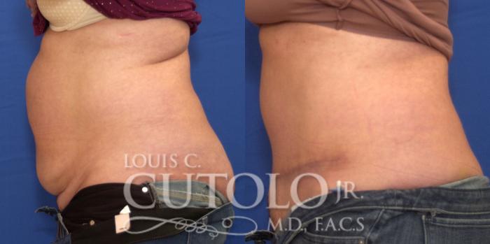 Before & After Tummy Tuck Case 205 View #3 View in Brooklyn, Staten Island, Queens, NY