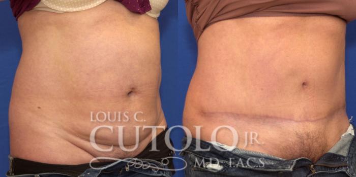 Before & After Tummy Tuck Case 205 View #4 View in Brooklyn, Staten Island, Queens, NY