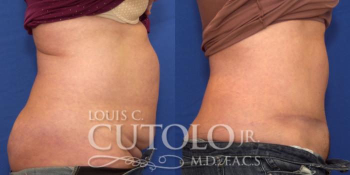 Before & After Tummy Tuck Case 205 View #5 View in Brooklyn, Staten Island, Queens, NY
