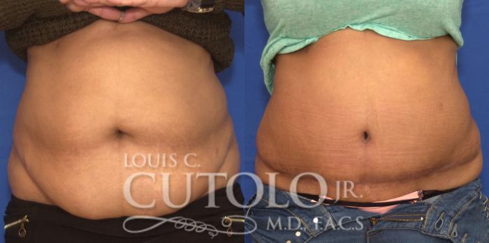 Before & After Tummy Tuck Case 207 View #1 View in Brooklyn, Staten Island, Queens, NY