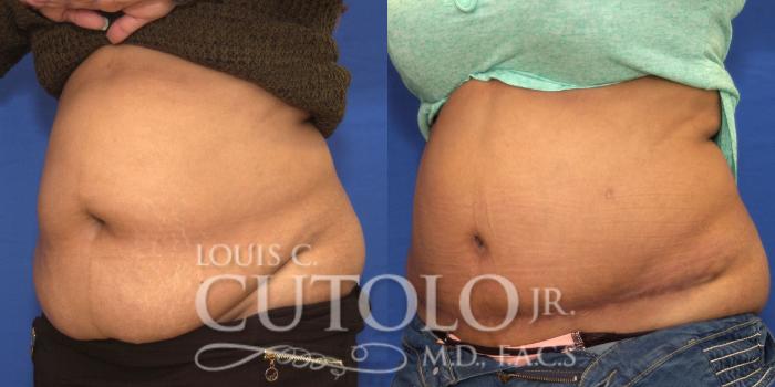 Before & After Tummy Tuck Case 207 View #2 View in Brooklyn, Staten Island, Queens, NY