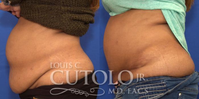 Before & After Tummy Tuck Case 207 View #3 View in Brooklyn, Staten Island, Queens, NY