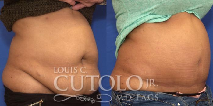 Before & After Tummy Tuck Case 207 View #4 View in Brooklyn, Staten Island, Queens, NY