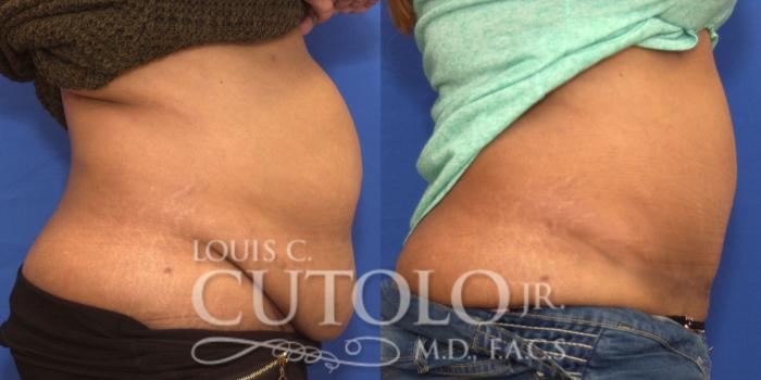 Before & After Tummy Tuck Case 207 View #5 View in Brooklyn, Staten Island, Queens, NY
